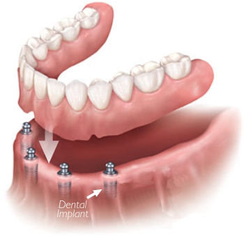 implant-dentures-2