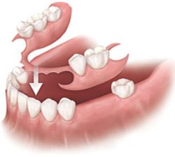 partial-dentures